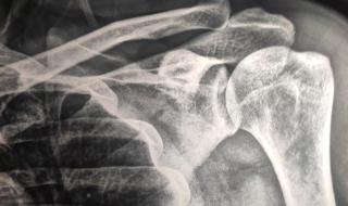 左肩膀痛警惕四种病